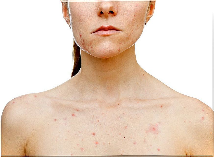 acne in women