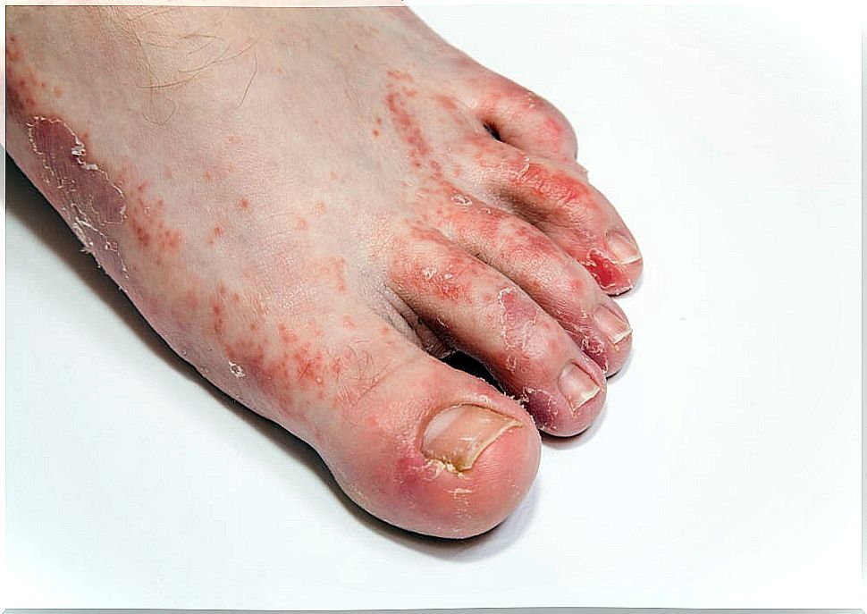 Foot with reddish rashes