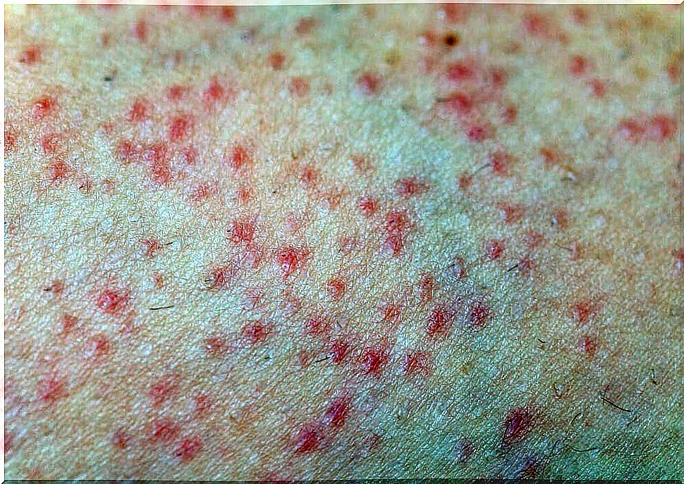 Skin with folliculitis