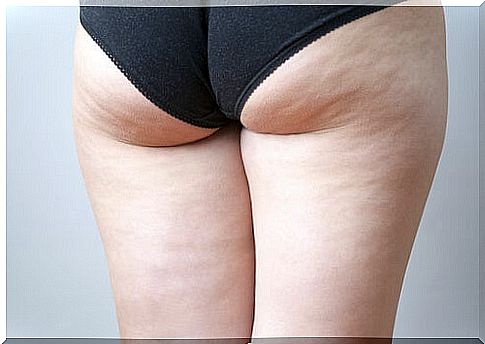 What is cellulite