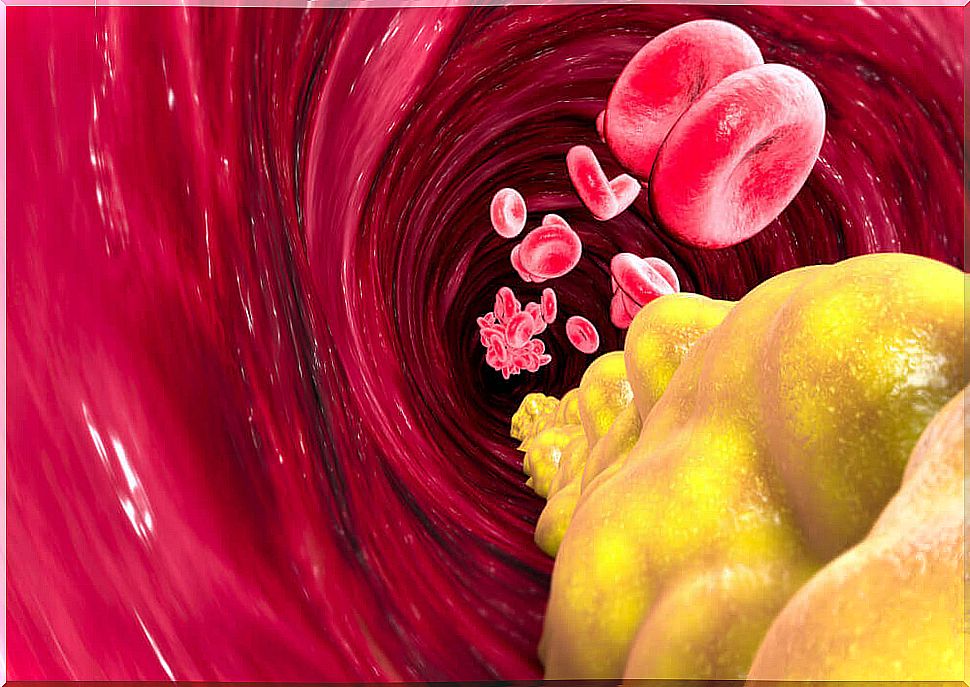 Cholesterol in the arteries.