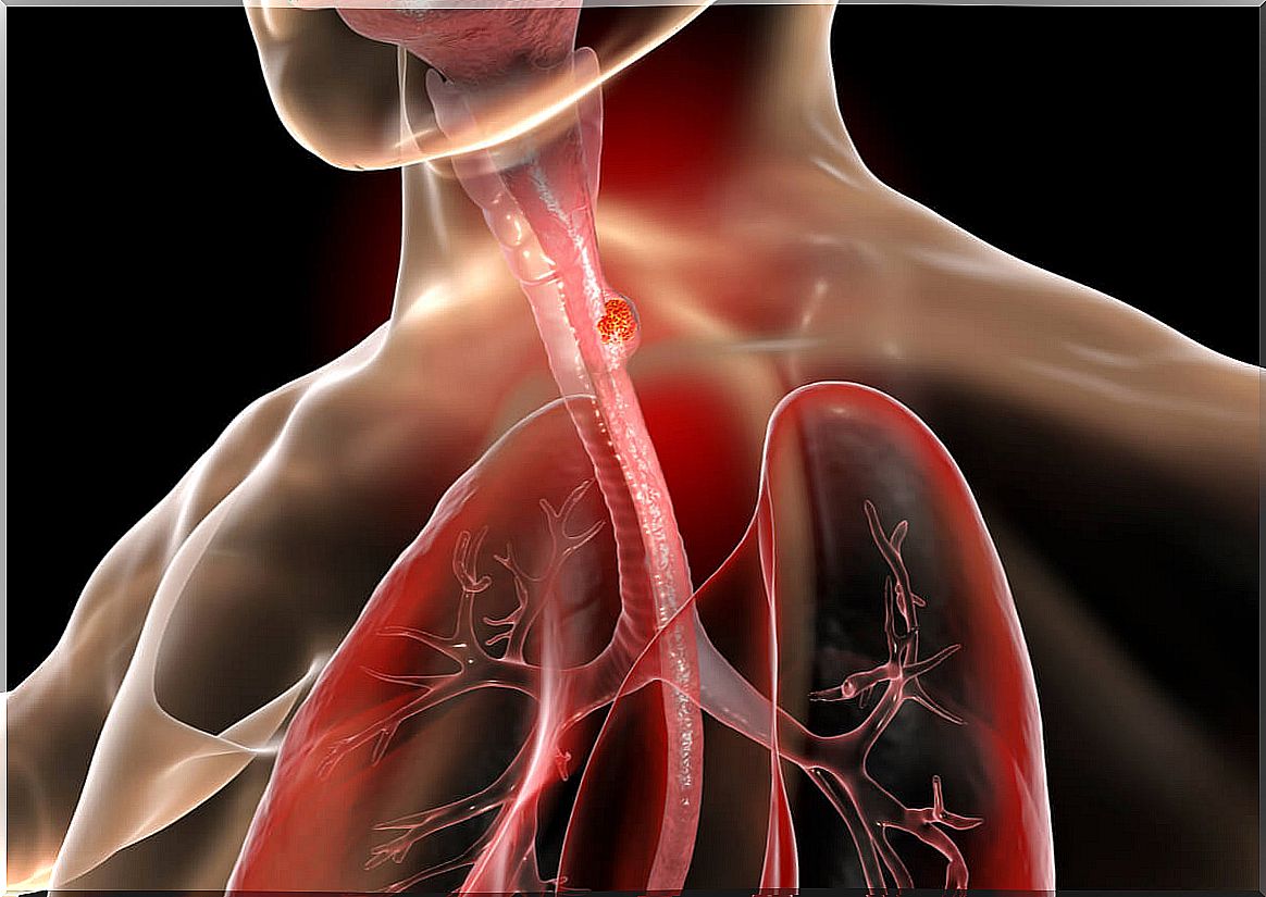 Obstruction in the esophagus.